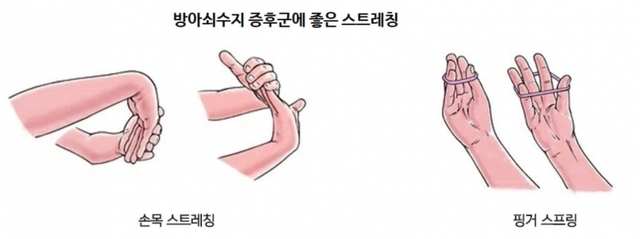 장안동 성형외과 손가락이 똑딱거리는 방아쇠 수지 증후군!